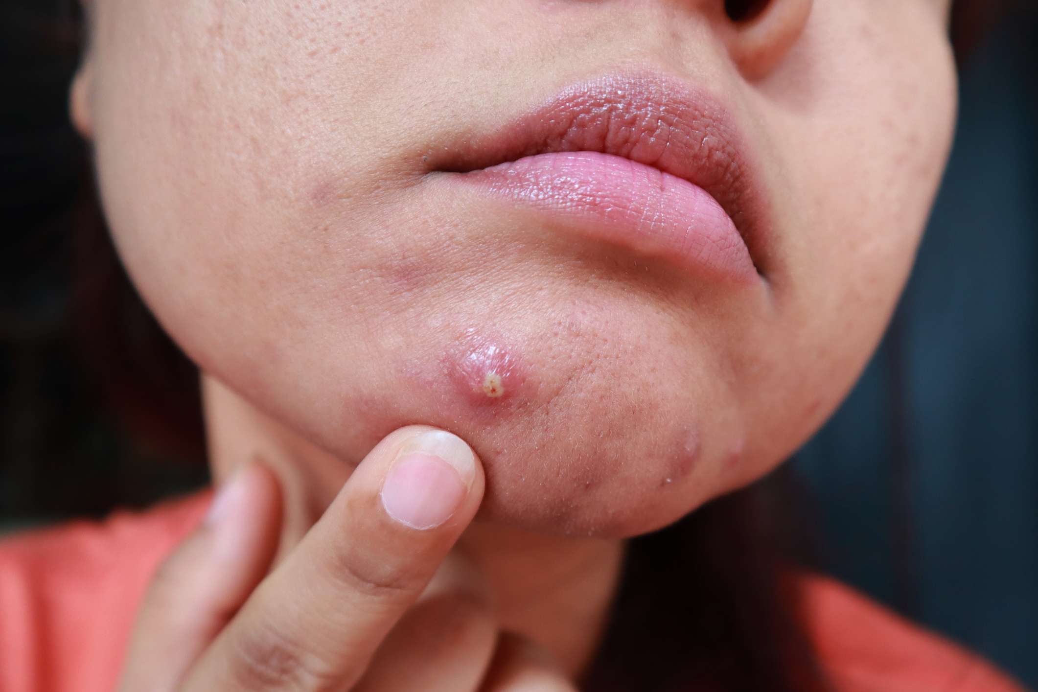 Cystic Acne: Treatment, Causes, and Prevention